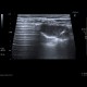 Lung infarction: US - Ultrasound